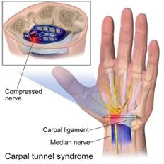 Staying Healthy Tip - How To Keep Your Wrists Pain Free